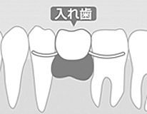 入れ歯のイメージ