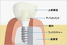 インプラントの構造についてのイメージ