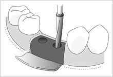 インプラント埋入のイメージ