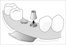 アバットメント装着のイメージ