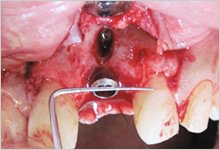 インプラント埋入と同時GBRのイメージ